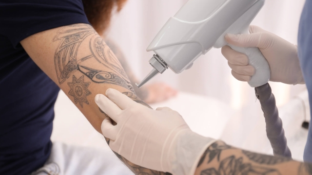 Removal Of Tattoo By Surgery, By Laser, Or By Product?