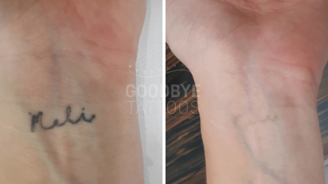 Tca Tattoo Removal – Removing A Tattoo By Your Forearm