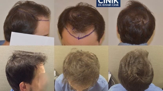 A Locks of Confidence: Unveiling the Secrets of Hair Transplants