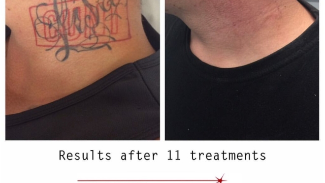 Running Through Reasons For Laser Tattoo Removal