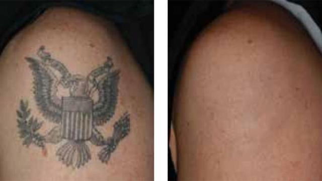 Tattoo Removal Made Easy With Laser Devices