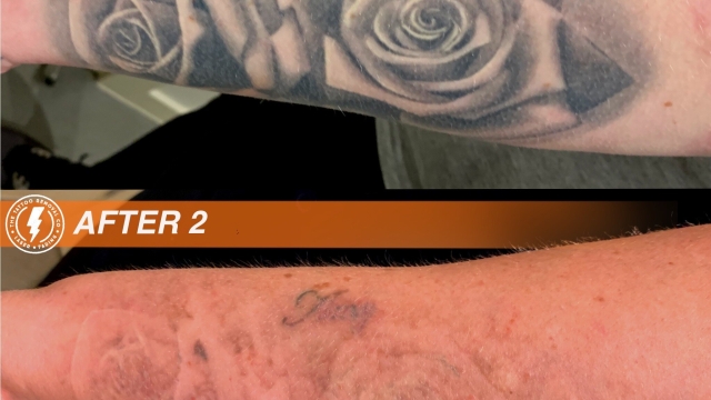Laser – The New Technology For Tattoo Disposal!