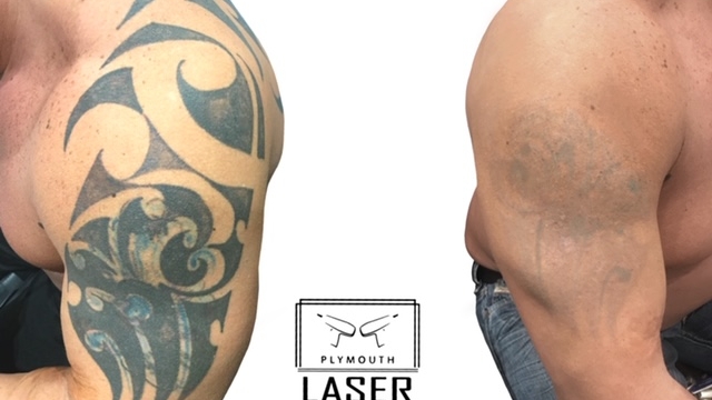 Removal Of Tattoo By Surgery, By Laser, Or By Balm?